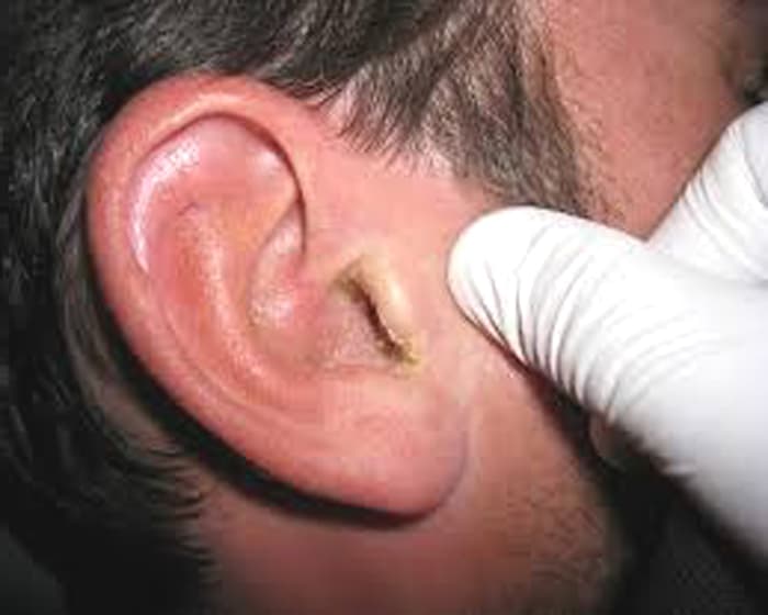 El 9 de noviembre se celebra el Día de la Microtia, un defecto congénito que implica una mala formación del oído